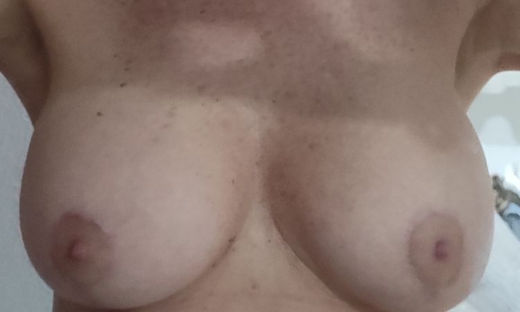 Necesito nueva cirugía de mastopexia por asimetría? - 64084