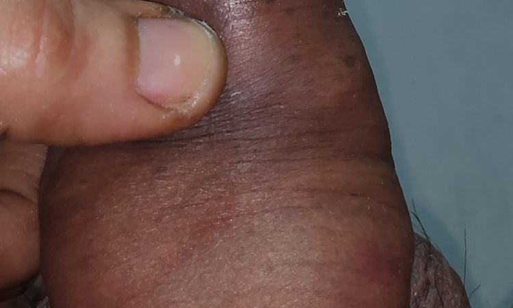 Engrosamiento de pene con acido hialuronico grosor en un solo lugar - 64411
