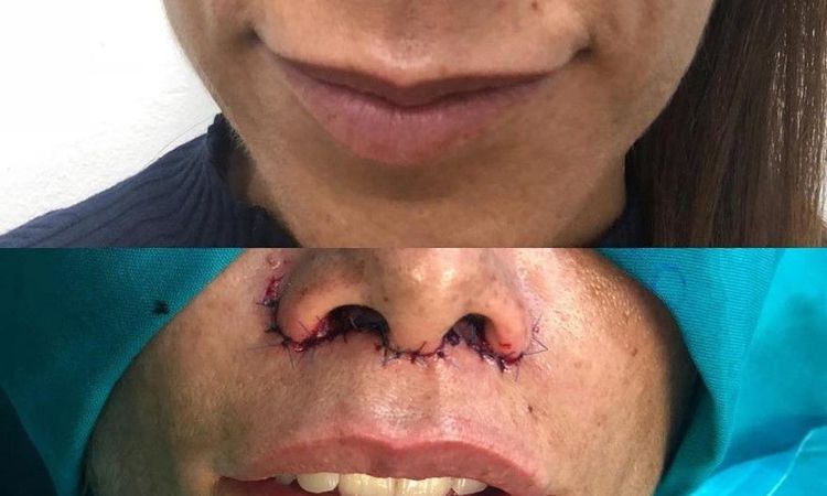 ¿Lifting labios sin descolgamiento? - 64564