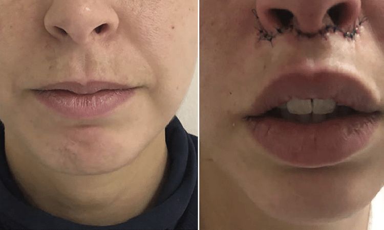 ¿Lifting labios sin descolgamiento? - 64565