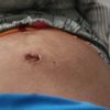 Abdominoplastia. Hace 3 dias con ombligo rojo y alterado y abdomen inchado