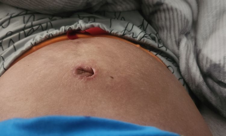 Abdominoplastia. Hace 3 dias con ombligo rojo y alterado y abdomen inchado - 64604