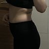 Emsculpt es una buena opción para eliminar grasa abdominal?