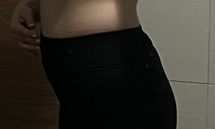 Emsculpt es una buena opción para eliminar grasa abdominal? - 64895