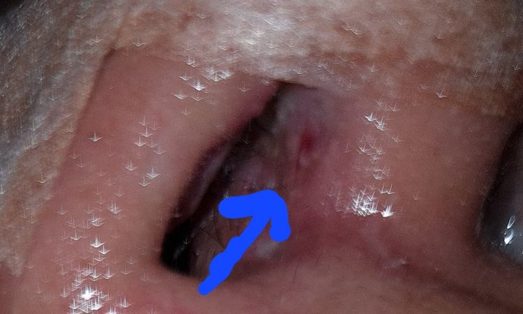 Granito rojo con punto blanco rinoplastia - 65166