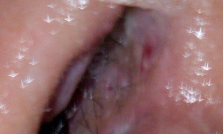 Granito rojo con punto blanco rinoplastia - 65167