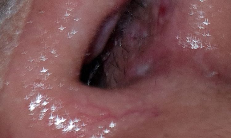 Granito rojo con punto blanco rinoplastia - 65168