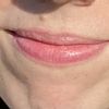 Resultado labios ácido hialuronico
