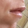 Resultado labios ácido hialuronico