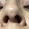 Hilo tensor en nariz
