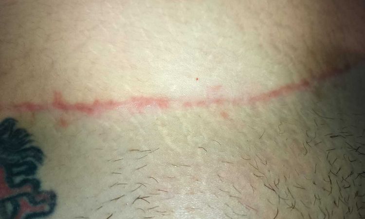 Expectativas de cicatrización posiblemente queloide - 65743