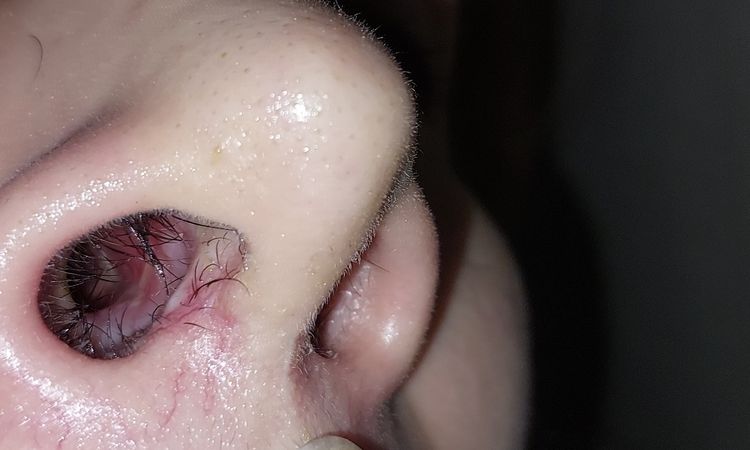 Cicatrización tras rinoseptoplastia con injerto costal - 65793