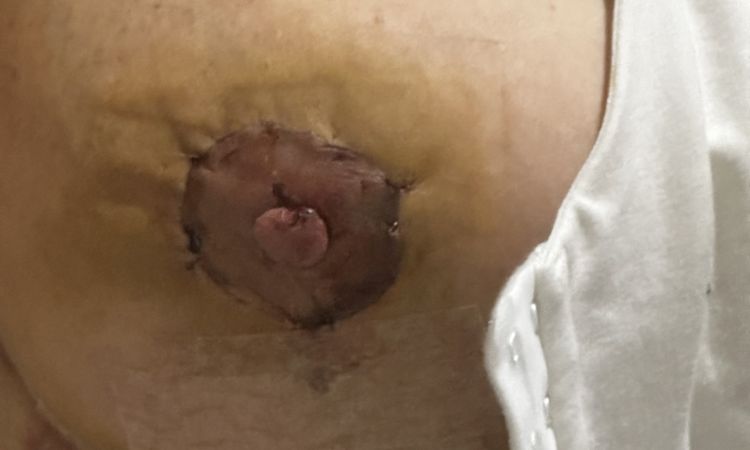 Areola más oscura tras mastopexia - 65806