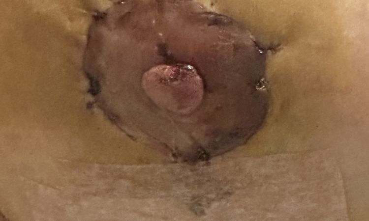 Areola más oscura tras mastopexia - 65807