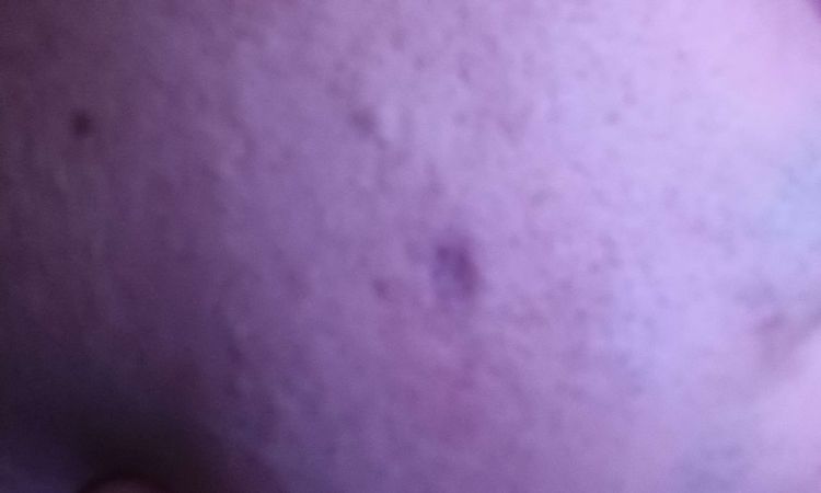 Cicatriz de lunares que me saqué hace 1 mes - 65865