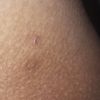 Verrugas debajo de glúteos