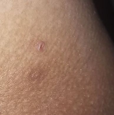 Verrugas debajo de glúteos - 65922