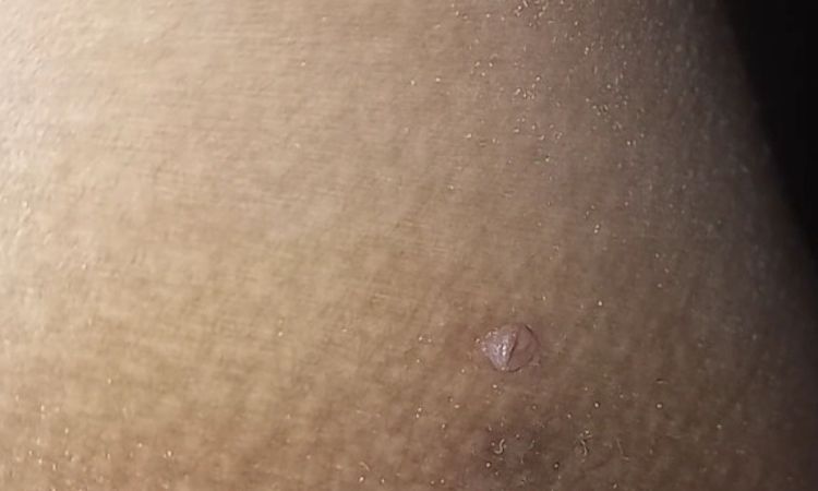 Verrugas debajo de glúteos - 65924