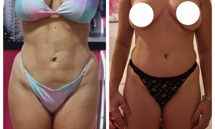 Liposucción con bodytime resultados negativos - 66021