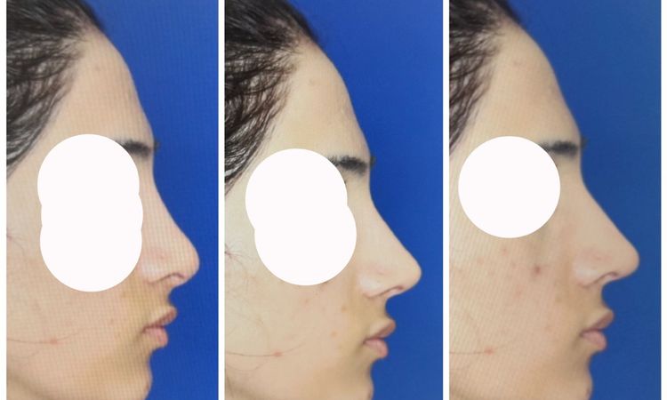 Es posible Rinoplastia secundaria de aumento - 66247