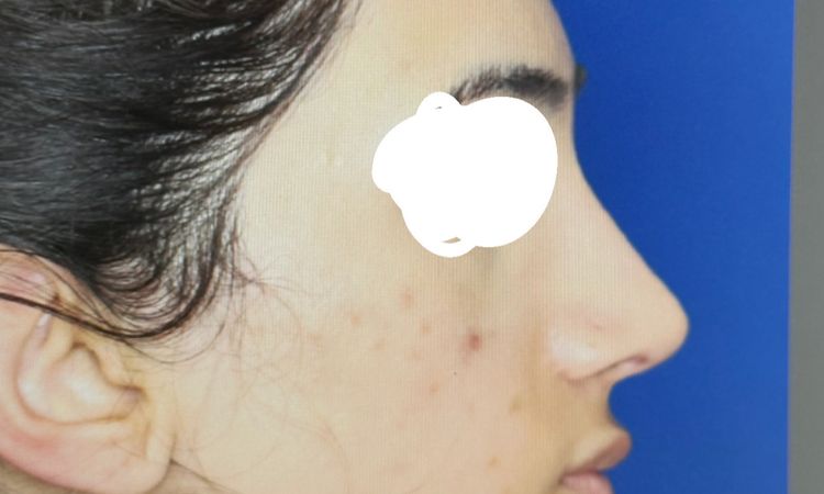 Es posible Rinoplastia secundaria de aumento - 66249