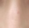 Ojeras tras acido hialurónico en pómulos y nasogenianos