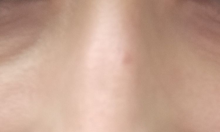 Ojeras tras acido hialurónico en pómulos y nasogenianos - 66564