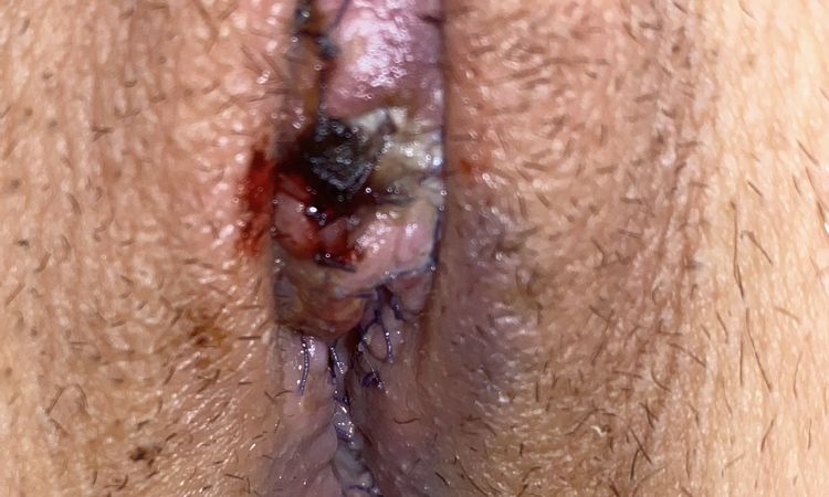Labioplastia después de 5 días - 66591