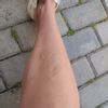 Venas dolorosas e inflamadas tras pantalón muy ajustado