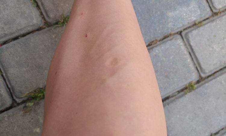 Venas dolorosas e inflamadas tras pantalón muy ajustado - 66601