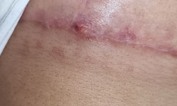 Bulto blanco en cicatriz mastopexia que puede ser - 66732