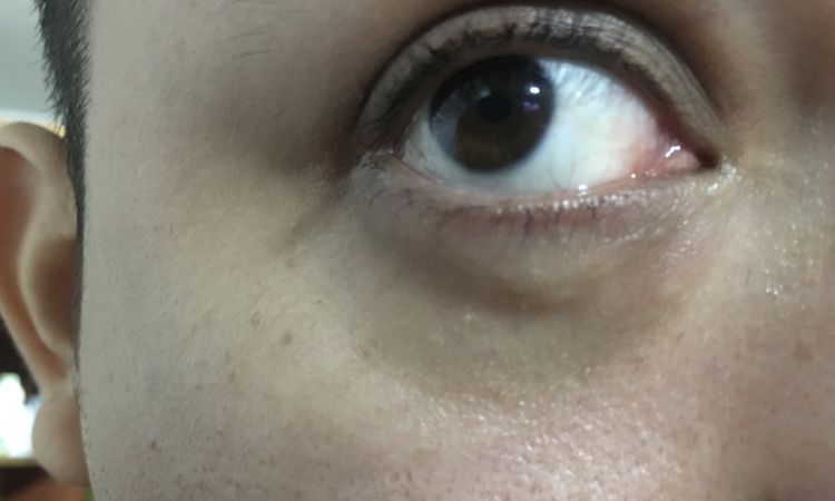 Blefaroplastia transconjuntival - 66850