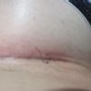 Herida con liquido no cierra