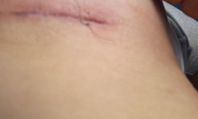 Herida con liquido no cierra - 66878