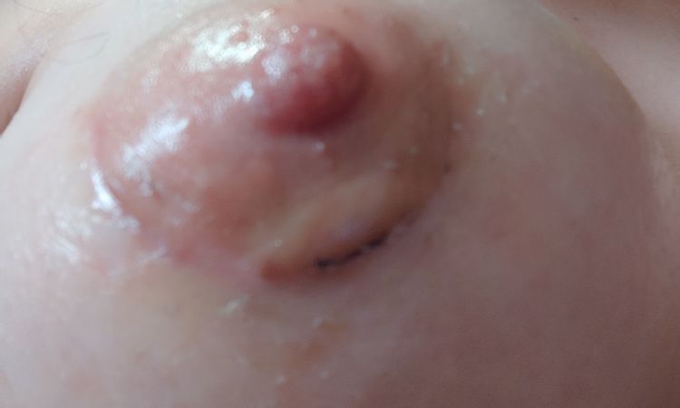 Inflamación areola en cicatriz - 67036