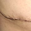 Orejas de perro en abdominoplastia