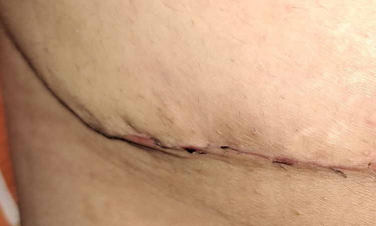 Orejas de perro en abdominoplastia - 67121