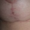 Expulsión de hilos mastopexia sin implantes