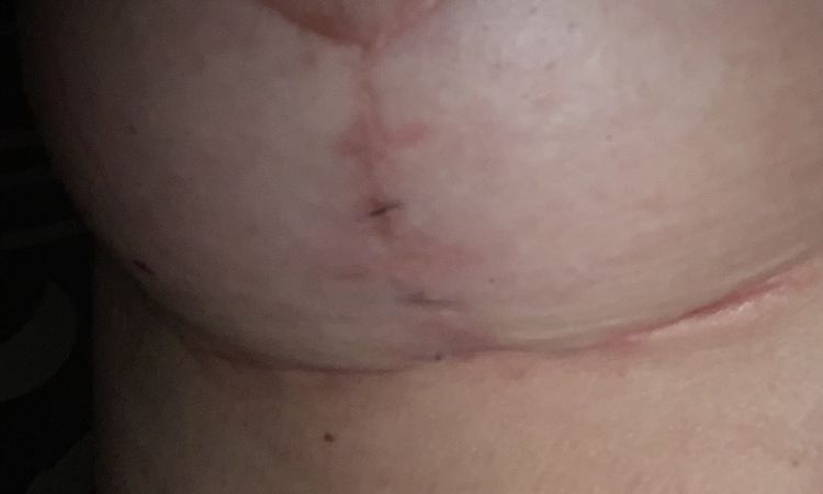 Expulsión de hilos mastopexia sin implantes - 67572