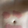 Urticaria tres semanas despues de Aqualyx