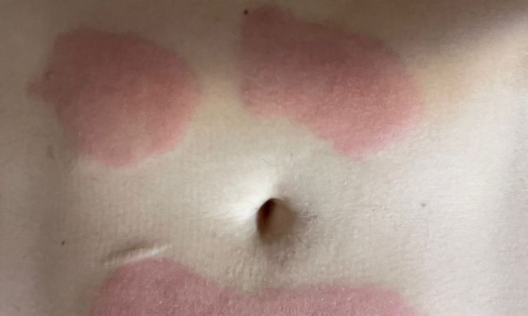 Urticaria tres semanas despues de Aqualyx - 67599