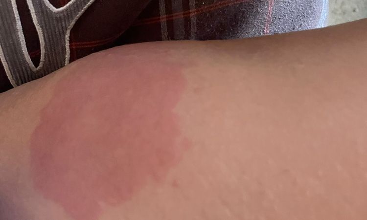 Urticaria tres semanas despues de Aqualyx - 67600