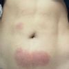Urticaria tres semanas despues de Aqualyx