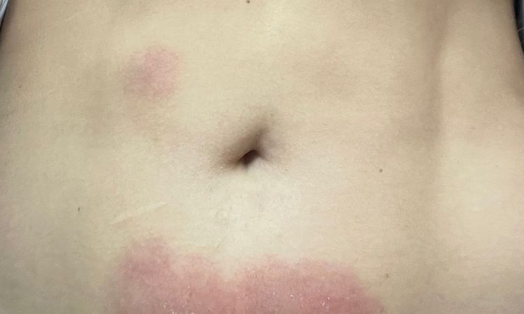 Urticaria tres semanas despues de Aqualyx - 67601
