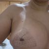 Implante deforme después de cambio de prótesis