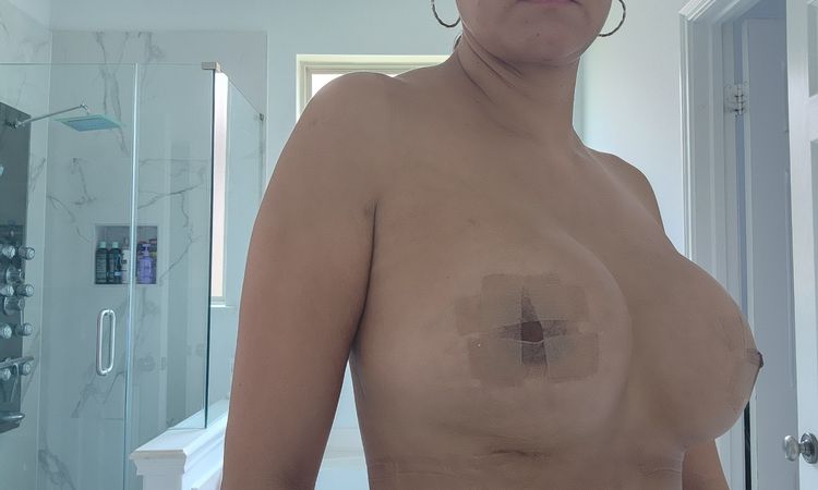 Implante deforme después de cambio de prótesis - 67825
