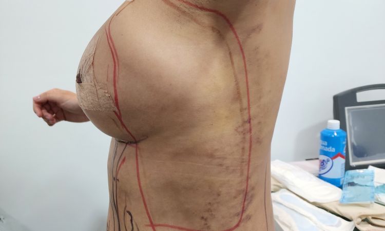 Implante deforme después de cambio de prótesis - 67826