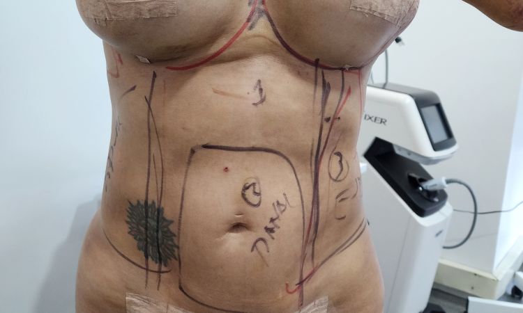 Implante deforme después de cambio de prótesis - 67828