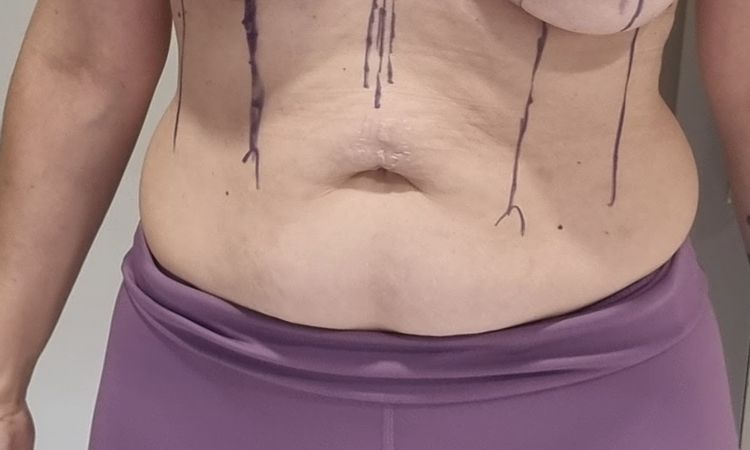 Maxtopexia con implantes motiva round - 68086