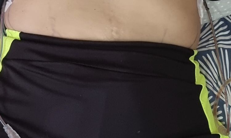 Maxtopexia con implantes motiva round - 68087
